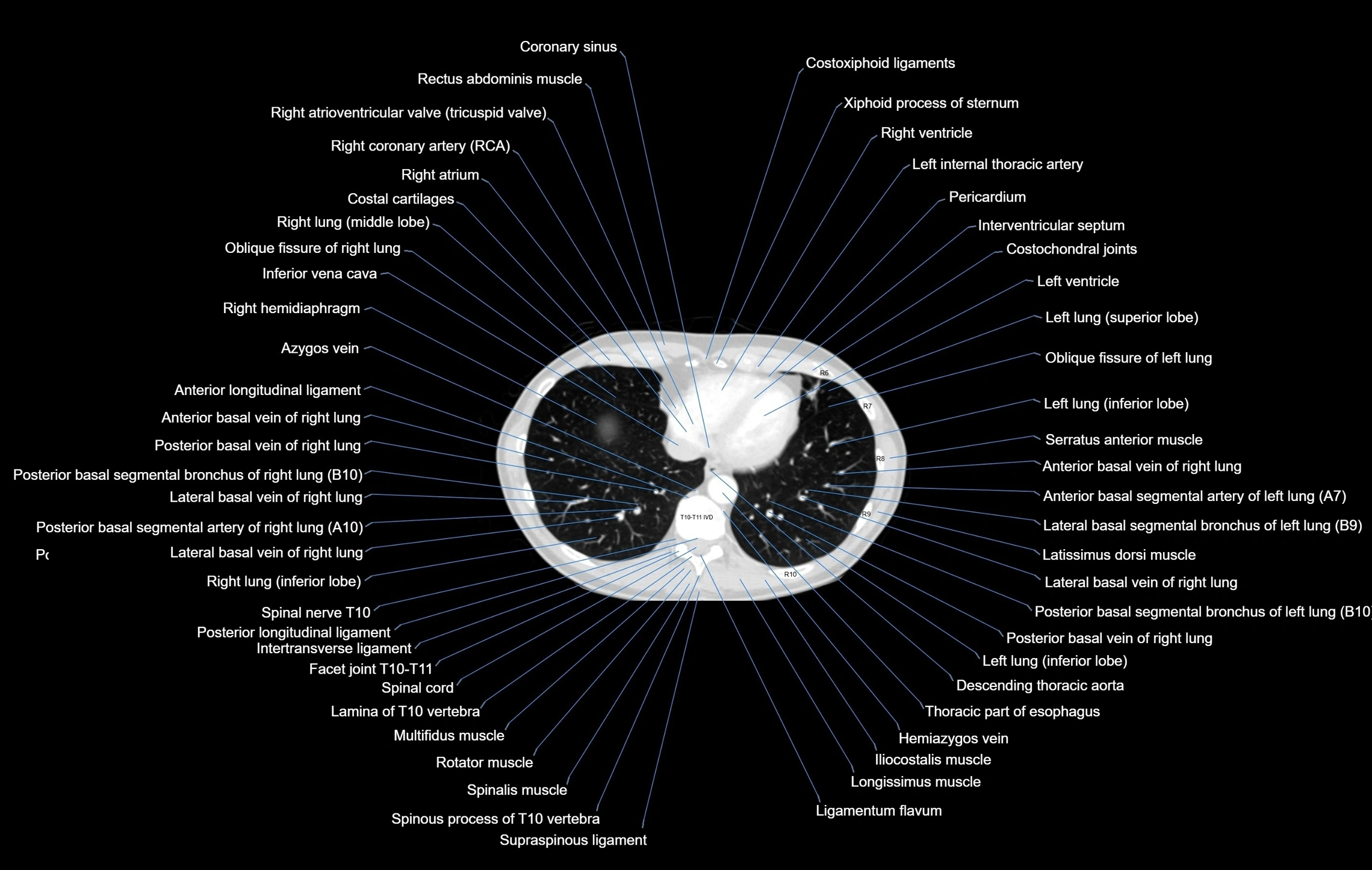 CT chest (thorax) labelled axial cross sectional anatomy radiology image-00091.webp
